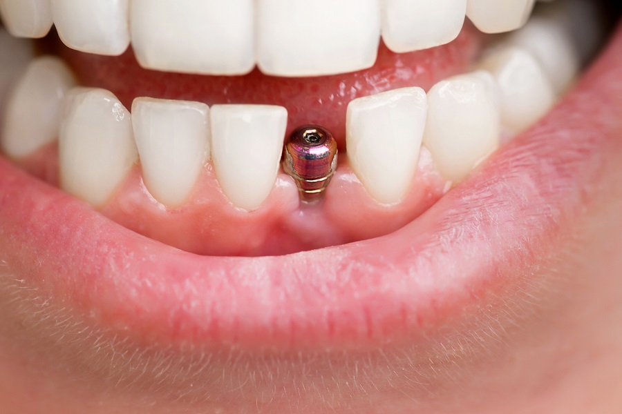 Placing Dental Implants
